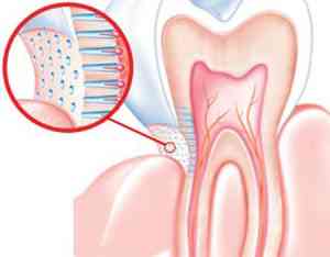 علاج الاسنان الحساسة