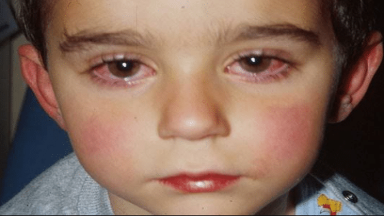 كيفية علاج حساسية العين عند الاطفال