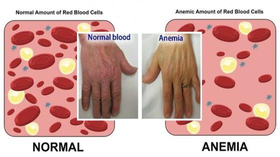 أعراض وعلاج أنيميا نقص الحديد